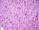 Subcutaneous desmoid fibromatosis
