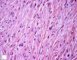 Subcutaneous desmoid fibromatosis