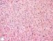Subcutaneous desmoid fibromatosis