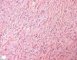 Subcutaneous desmoid fibromatosis