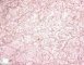 TFE3 positivity in pediatric renal cell carcinoma