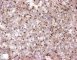 TFEB positivity in HMB45+ renal cell tumor