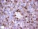 TFEB positivity in HMB45+ renal cell tumor