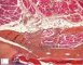 Thyroglossal tract near hyoid bone