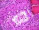 Foamy macrophages in renal tubules