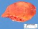 Nodal Castleman disease