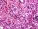 Nuclear and cytoplasmic inclusions in CMV fetopathy