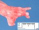 Hand ectrodactyly