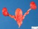 Megacystis-microcolon syndrome (Case #11183)