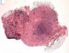 Mediastinal poorly differentiated neuroblastoma (Case 11541)