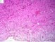 Myxoid liposarcoma
