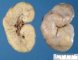 ARPKD kidney in a neonate (1 month)
