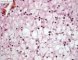 Hepatic glycogenosis
