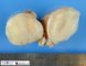Localized neurofibroma in neurofibromatosis type 1