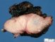 Sacrococcygeal teratoma (SCT) (Macroscopy)