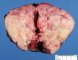 Renal malignant rhabdoid tumor