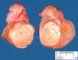 Testicular dermoid cyst