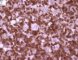 CD3 in mixed cellularity Hodgkin lymphoma
