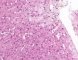 Niemann-Pick disease type B