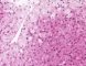 Niemann-Pick disease type B