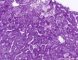 Niemann-Pick disease type B (PAS)