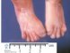 Polysyndactyly