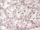 TFE3 positivity in pediatric renal cell carcinoma