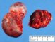 Cystic adrenal in in Beckwith-Wiedemann syndrome (fetus 27 weeks)