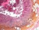 Acute appendicitis