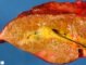 Dilatation of large bile ducts in extrahepatic biliary tract (...)
