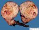 Cystic Wilms tumor