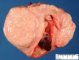 Endometrial polyp