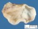 Mediastinal esophageal duplication cyst (primitive foregut cyst)