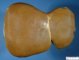 Falciform ligament of the liver
