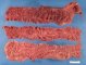 Familial adenomatous polyposis (FAP)