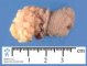 Fibrolipoma