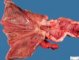 Crohn ileitis (Ileal Crohn disease)