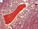 Bone marrow infiltration by large myeloid cells in Kostmann (...)