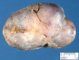Mammary fibroadenoma