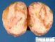 Myxoid degeneration of an uterine leiomyoma
