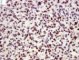 Myogenin in myxoid embryonal rhabdomyosarcoma (Orbit)