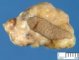Pilomatrixoma