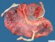 Triple pregnancy placenta