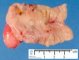 Meckel diverticula