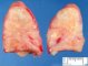 Mycobacterial granulomatous adenitis