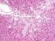 Niemann-Pick disease type B