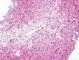 Niemann-Pick disease type B