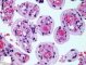 Placental mucolipidosis