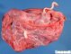 Diamniotic monochorionic placenta in twin-twin transfusion syndrome