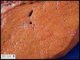 Micronodular cirrhosis in lysosomal acid lipase deficiency
